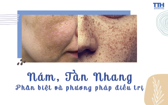 NÁM, TÀN NHANG - PHÂN BIỆT VÀ PHƯƠNG PHÁP ĐIỀU TRỊ