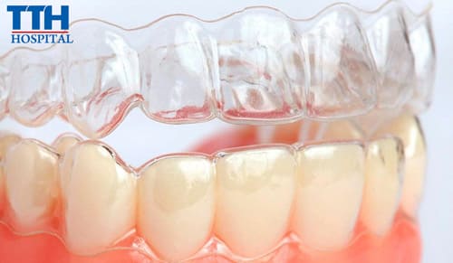 Niềng răng trong suốt có hiệu quả không?