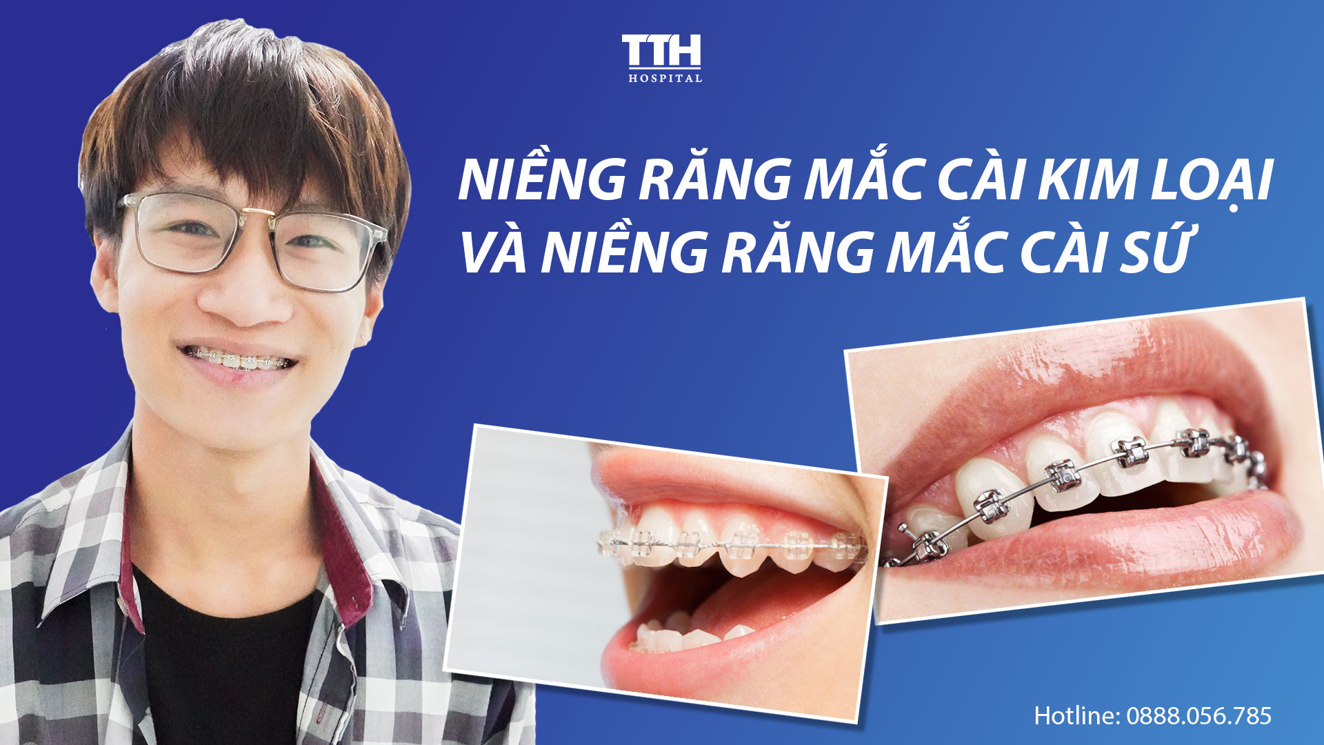 Niềng răng mắc cài kim loại và niềng răng mắc cài sứ