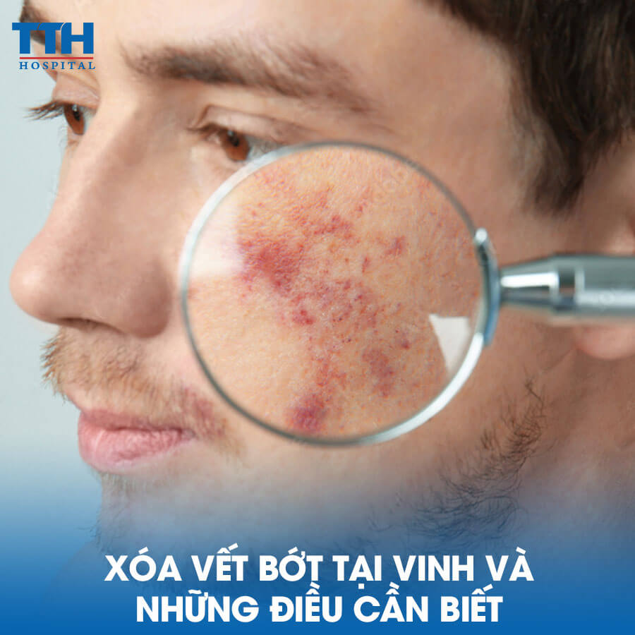 Xóa Vết Bớt Tại Vinh Và Những Điều Cần Biết