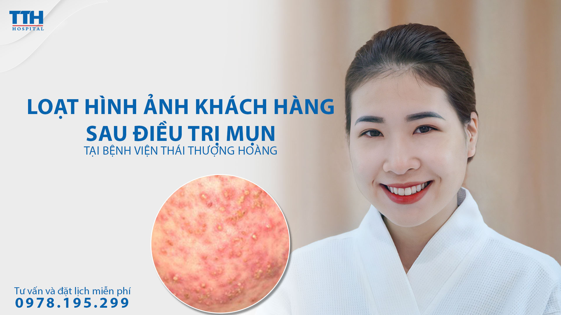 Loạt hình ảnh khách hàng sau điều trị mụn  tại Bệnh viện Thái Thượng Hoàng