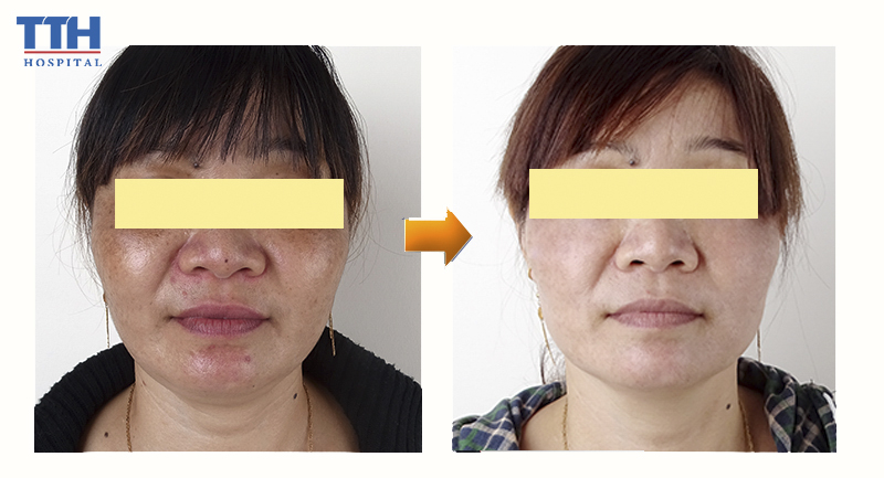Điều trị nám công nghệ Nd YAG
