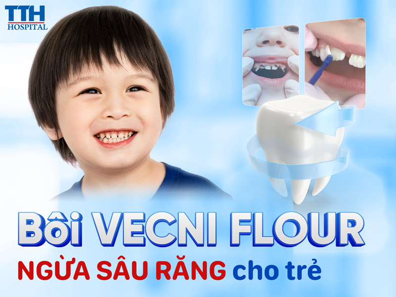 Bôi Vecni Fluor ngừa sâu răng cho trẻ