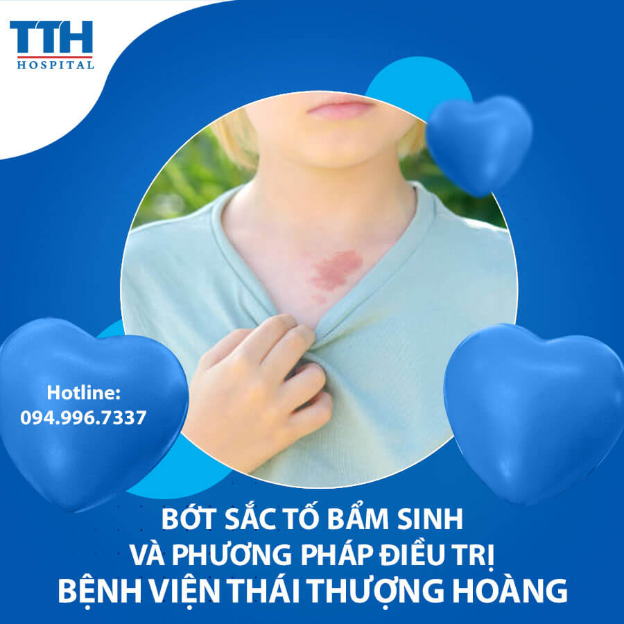 Bớt sắc tố bẩm sinh và phương pháp điều trị