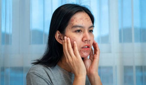 Các bước xử lý mụn viêm, mụn ẩn trước Tết 2025