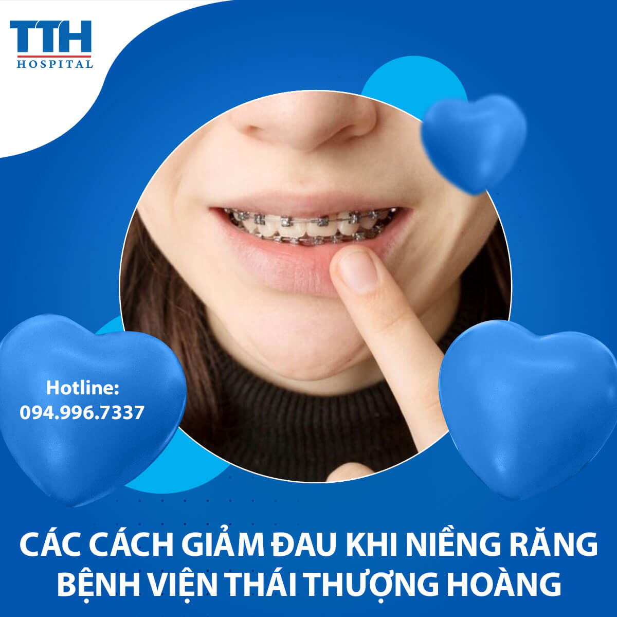 Các Cách Giảm Đau Khi Niềng Răng: Làm Thế Nào để Đối Phó Với Sự Khó Chịu?