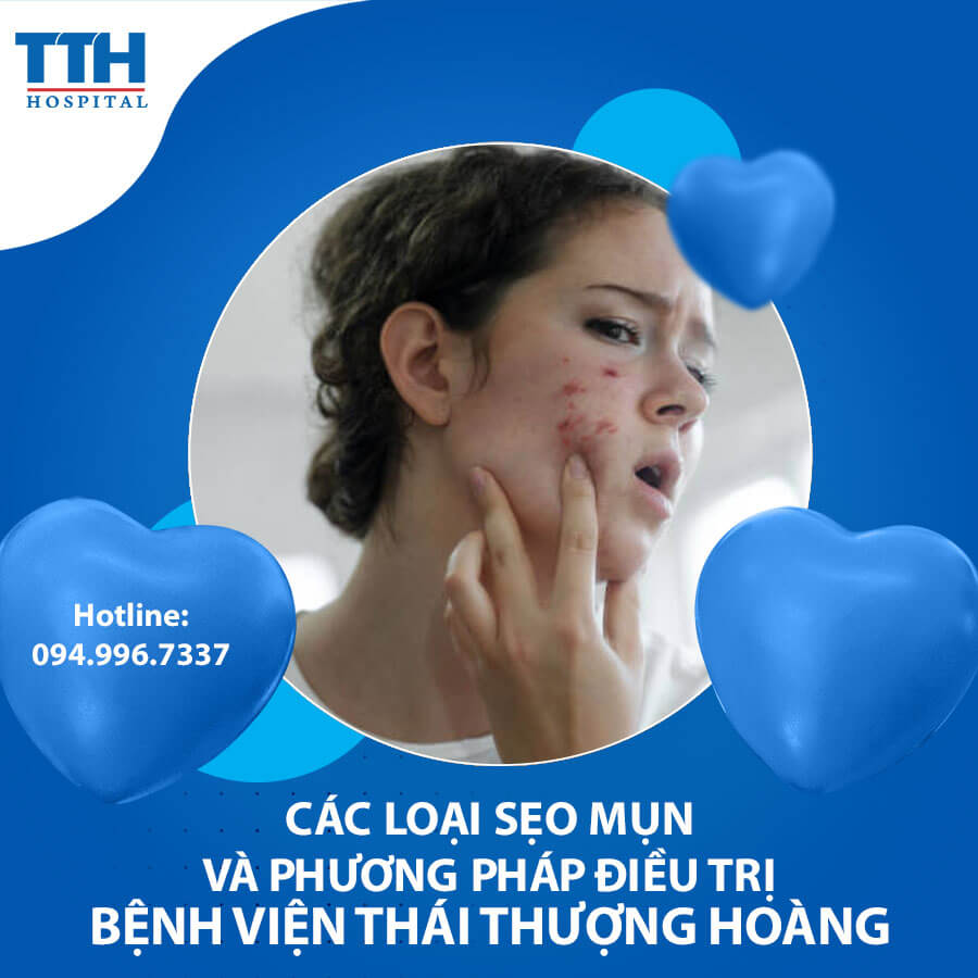 Các loại sẹo mụn và phương pháp điều trị