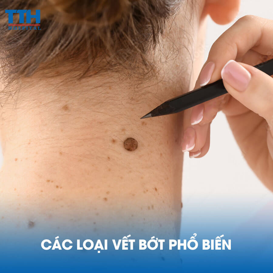Các Loại Vết Bớt Phổ Biến