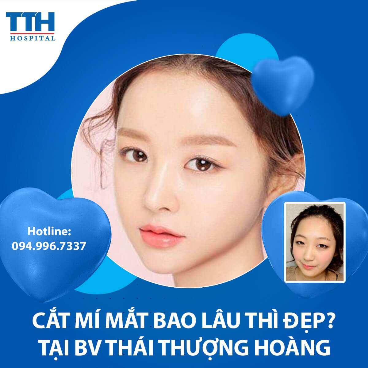 Cắt Mí Mắt Bao Lâu Thì Đẹp?