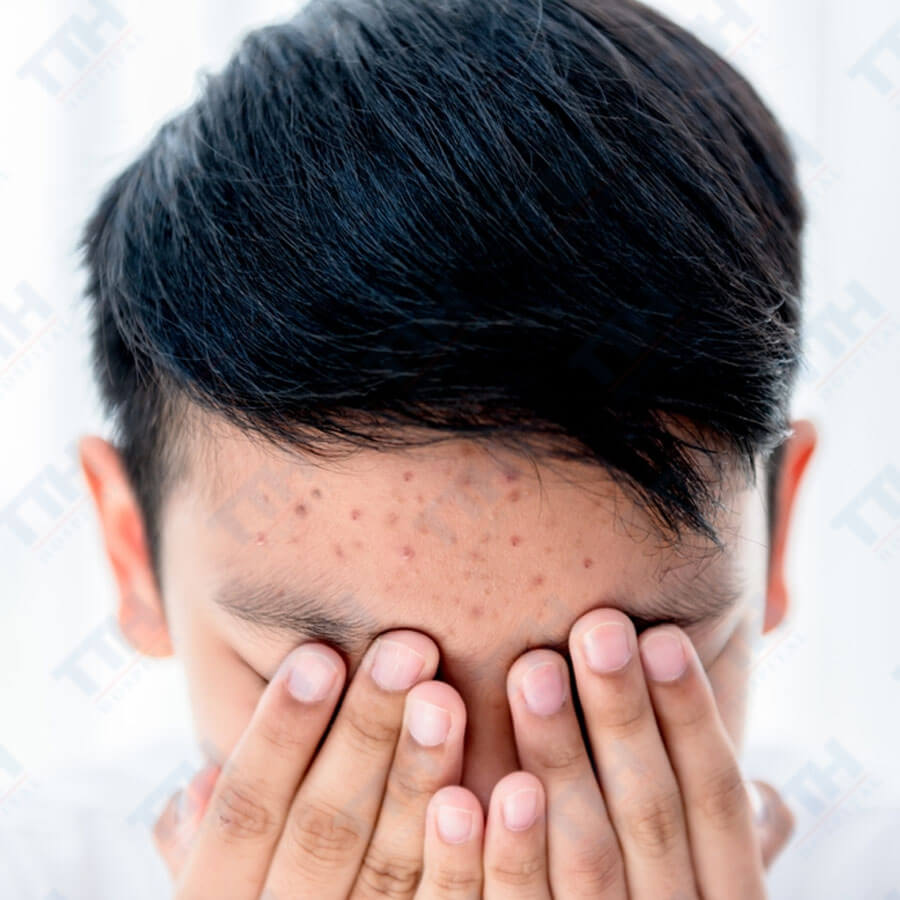 Chăm sóc da tuổi dậy thì như thế nào?
