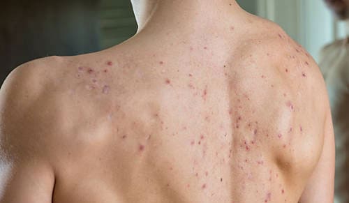 Có nên nặn mụn lưng không? Những điều cần biết