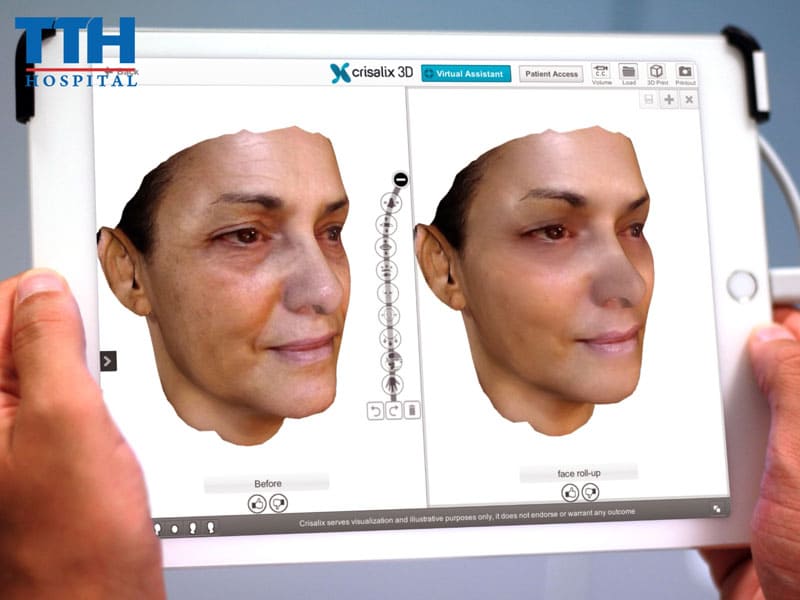 Crisalix 3d - công nghệ dự đoán kết quả thẩm mỹ tiên tiến tại bệnh viện thái thượng hoàng