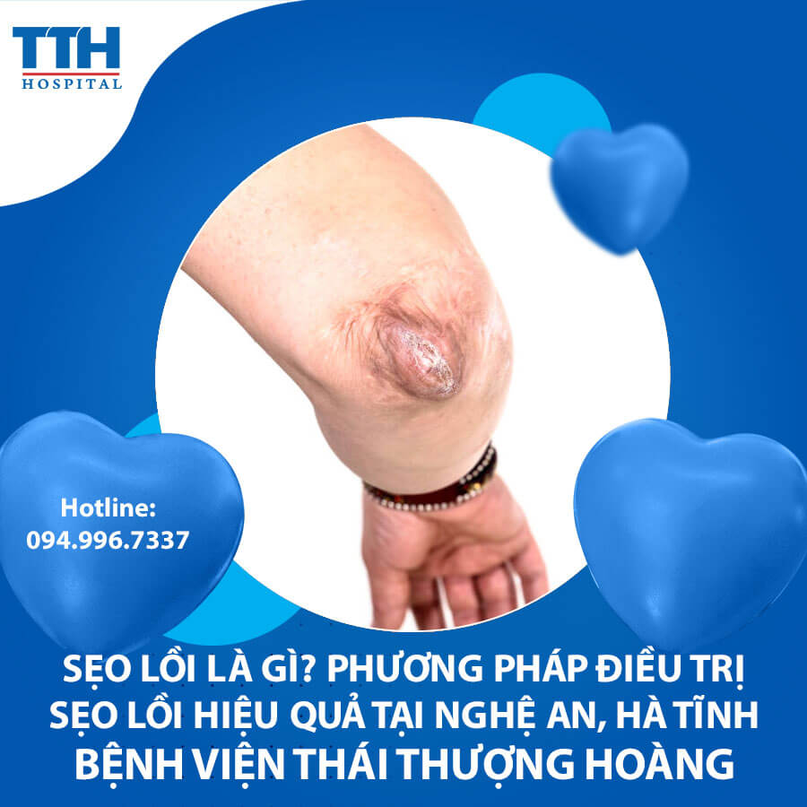 Điều trị sẹo lồi hiệu quả với công nghệ Laser CO2 Fractional