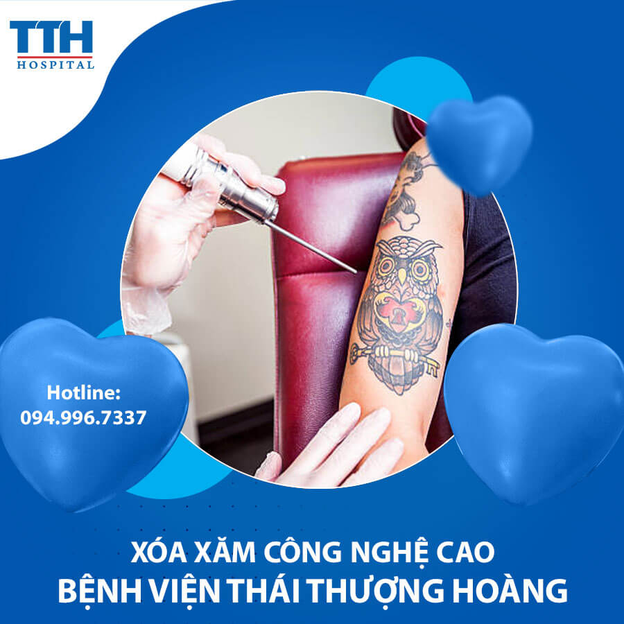 Xóa xăm công nghệ cao