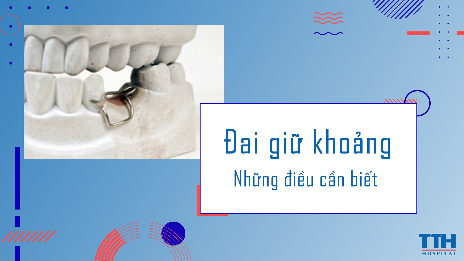 NHỮNG ĐIỀU CẦN BIẾT VỀ ĐAI GIỮ KHOẢNG