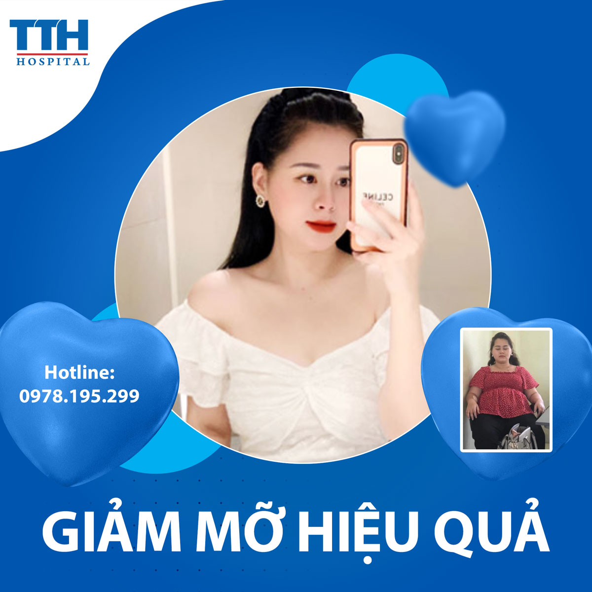 Hút mỡ BodyJet: Hiệu quả và an toàn cho việc giảm mỡ tại Vinh Nghệ An