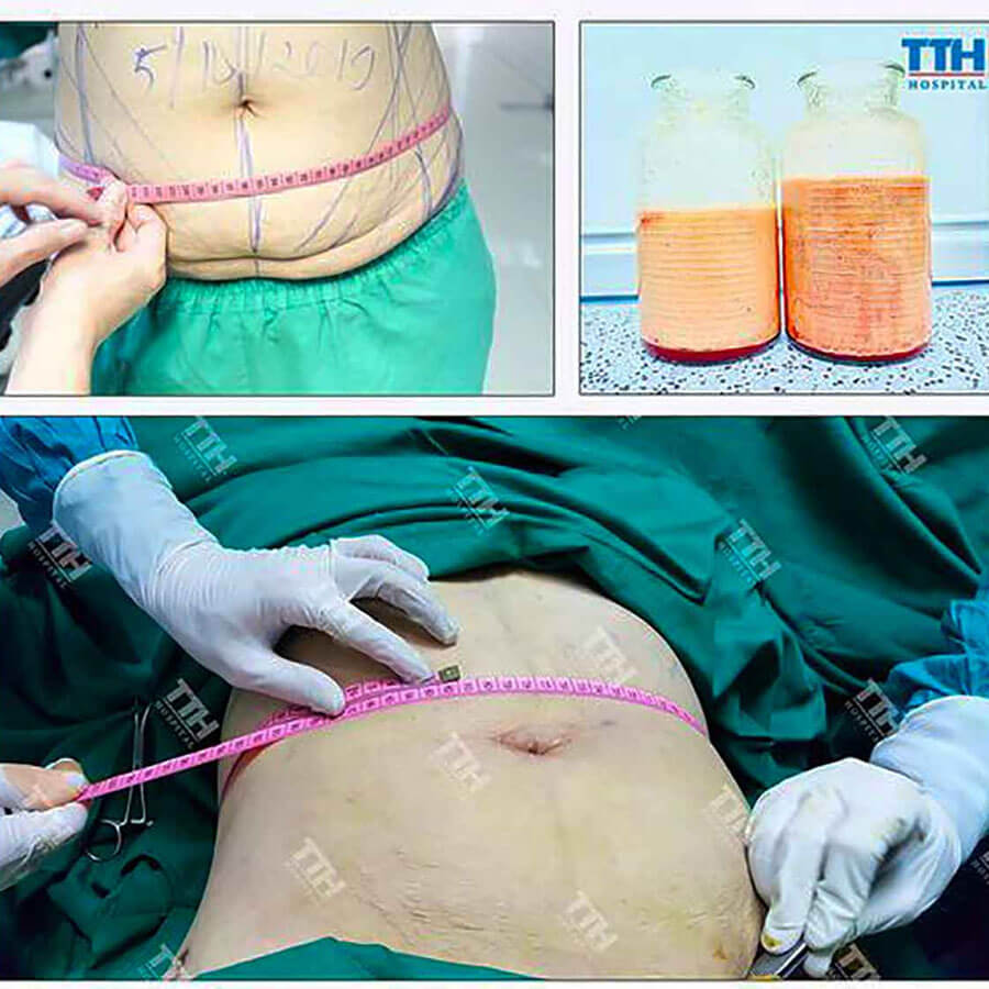Hút mỡ bụng an toàn, không phẫu thuật