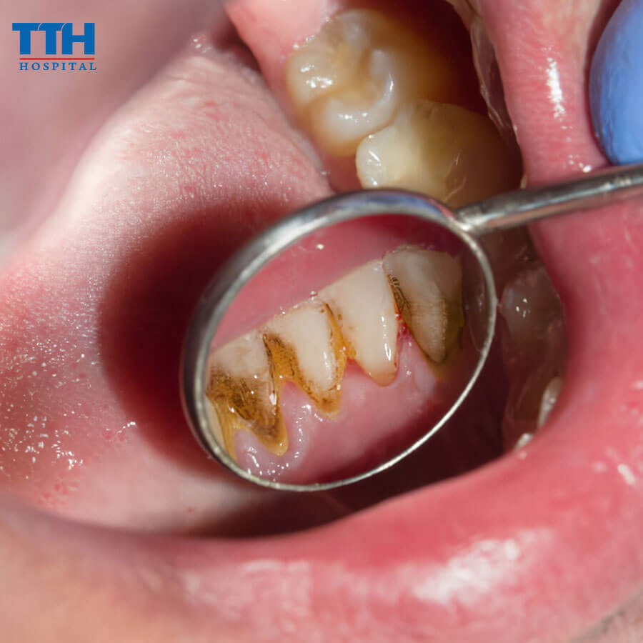 Lấy Cao Răng Tại Vinh Và Những Điều Cần Biết