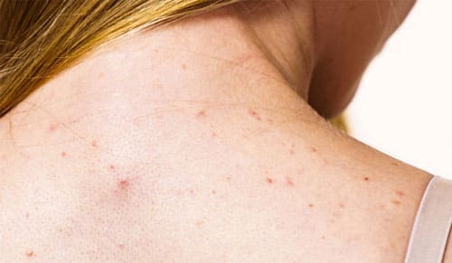 Mụn lưng dai dẳng: Nguyên nhân và giải pháp hiệu quả bạn nên biết