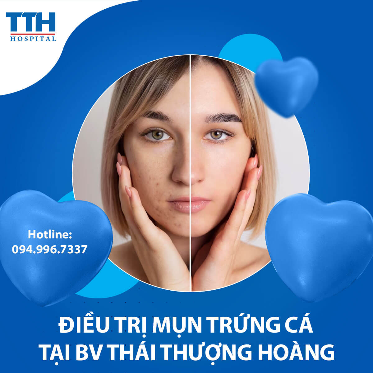 Mụn trứng cá và những điều cần biết
