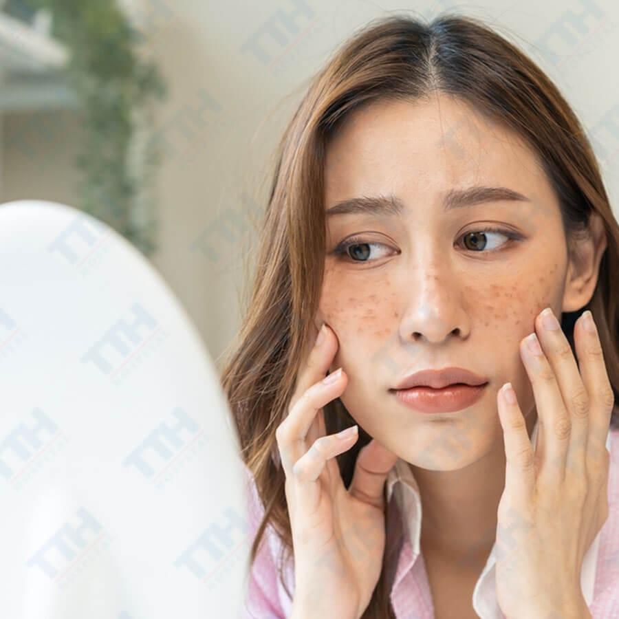 Nám cánh bướm là gì? Tất tần tật về loại nám phổ biến này