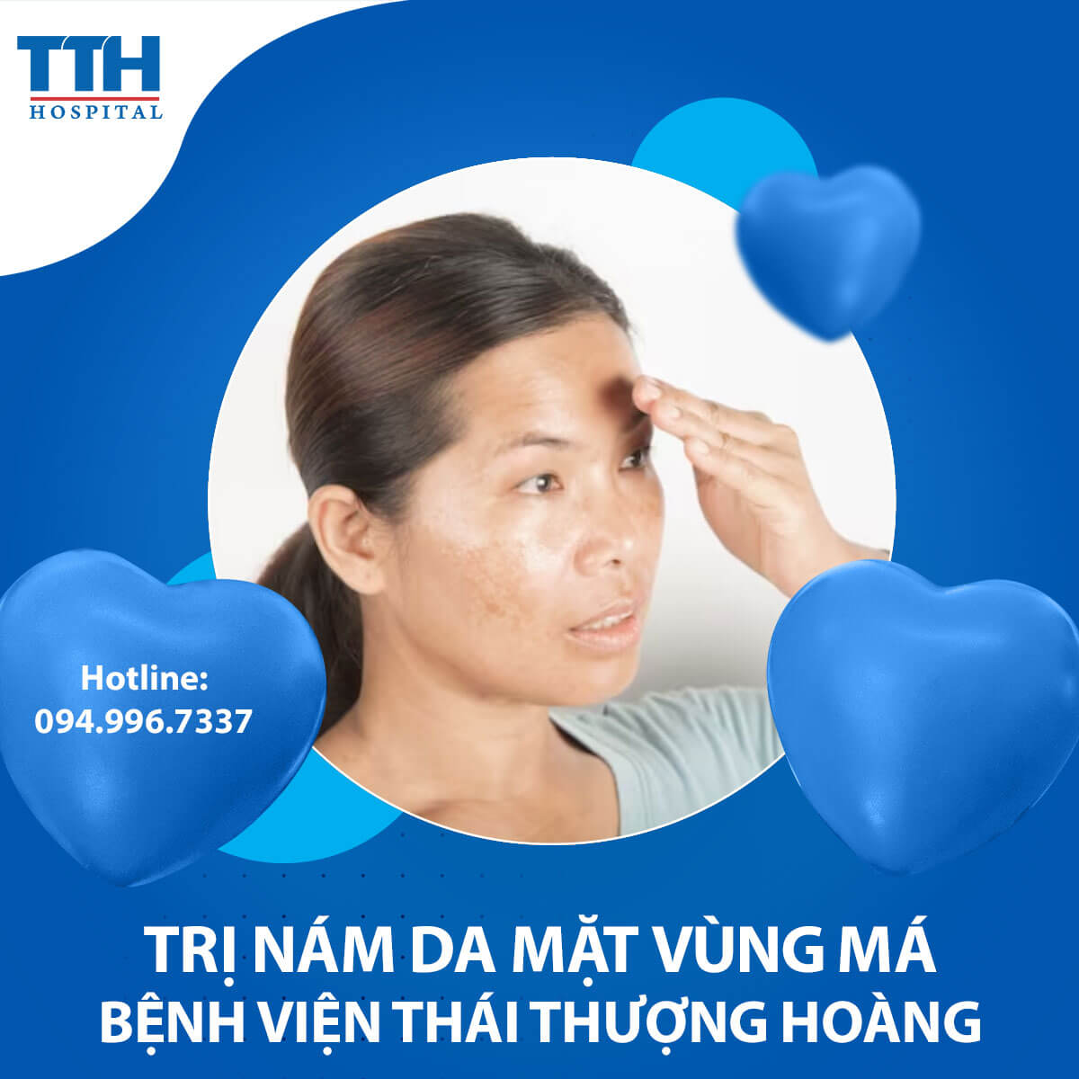 Nám da mặt vùng má - Nguyên nhân và cách điều trị