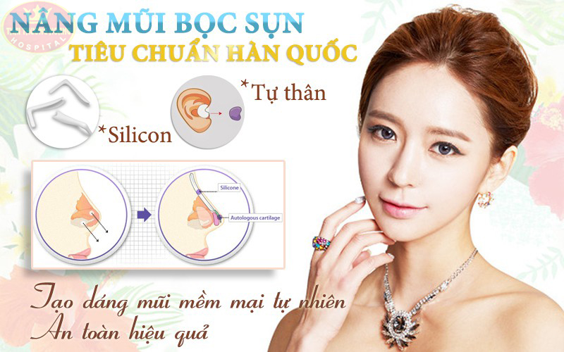 Nâng mũi bọc sụn tự thân