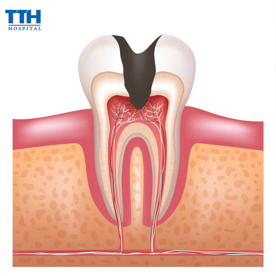 Những Bệnh Thường Gặp Ở Tủy Răng