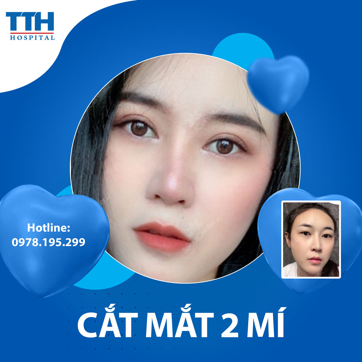 Những trường hợp nên cắt mí mắt
