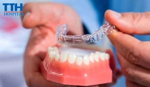 Những trường hợp nên niềng răng trong suốt