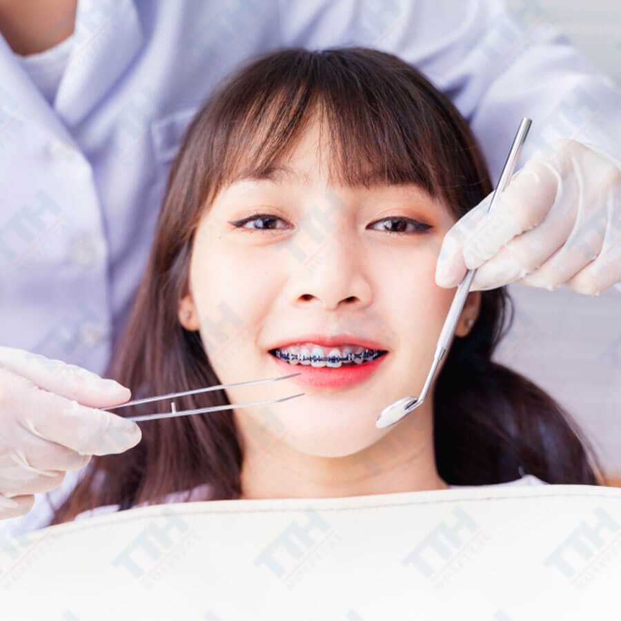 Niềng răng có được vĩnh viễn không? Giải đáp từ chuyên gia
