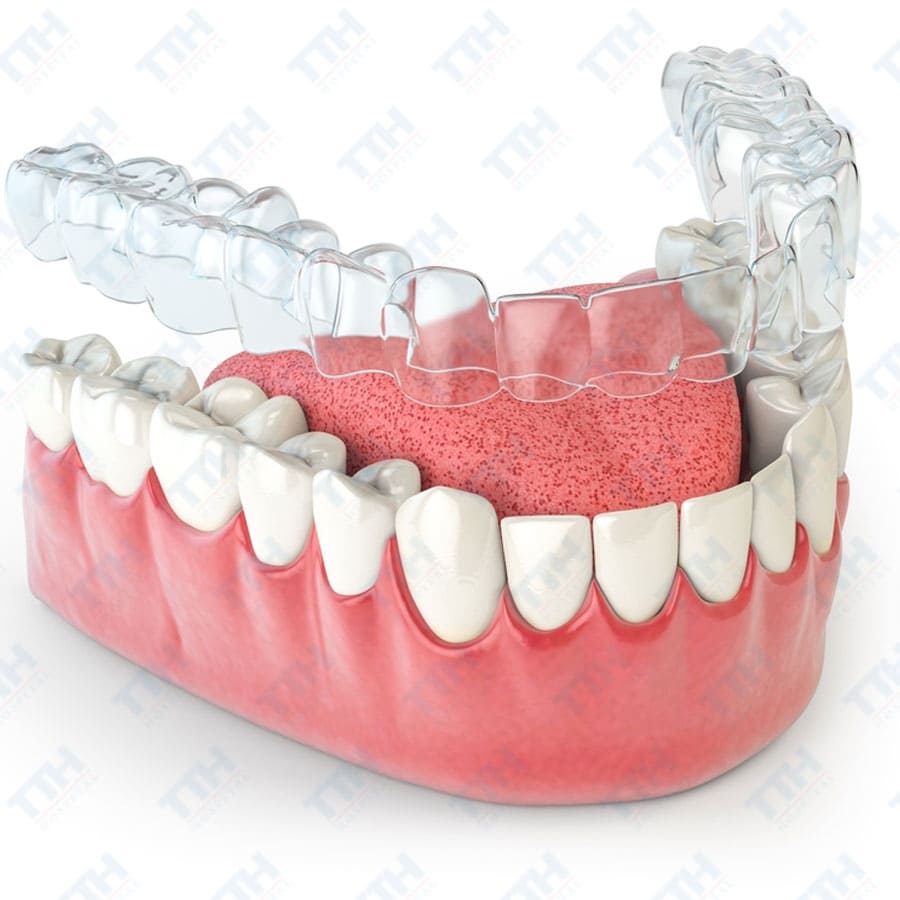 Niềng Răng Invisalign 1 Hàm: Có Hiệu Quả Không?