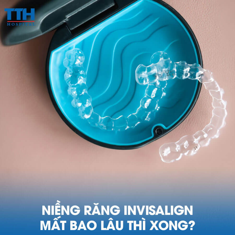 Niềng Răng Invisalign Mất Bao Lâu Thì Xong?
