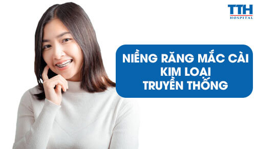 Niềng Răng Mắc Cài Kim Loại Truyền Thống: Hiệu Quả Và Những Điều Cần Biết