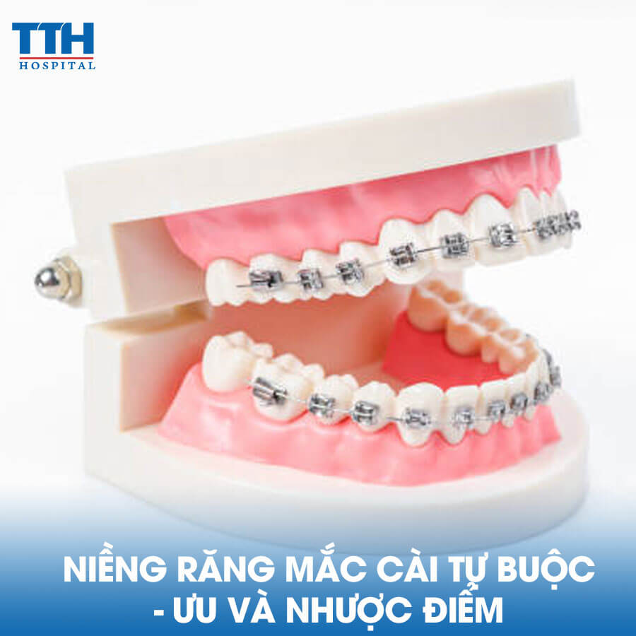 Niềng Răng Mắc Cài Tự Buộc - Ưu Và Nhược Điểm