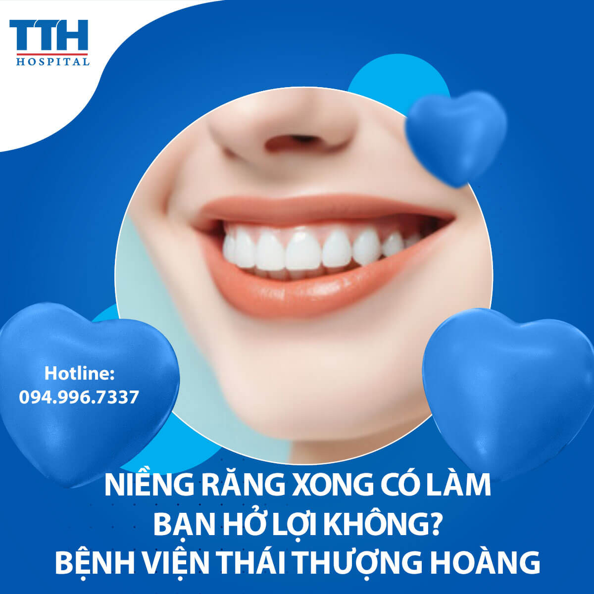 Niềng răng xong có làm bạn hở lợi không?