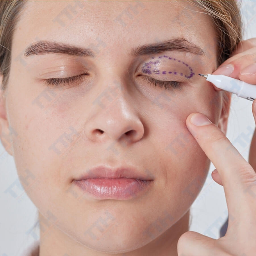 Phẫu Thuật Mí Trên Perfect Eyes TTH