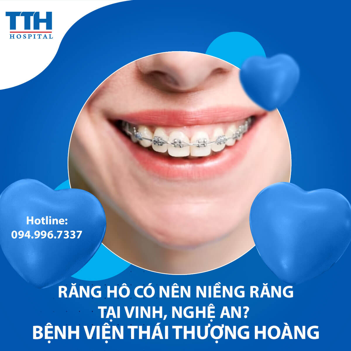 Răng hô có nên niềng răng tại Vinh, Nghệ An? - Chuyên gia chia sẻ