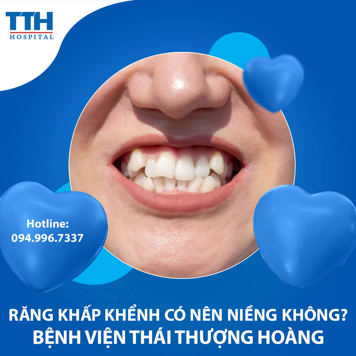 Răng khấp khểnh có nên niềng không? Chuyên gia nói gì về vấn đề này? 