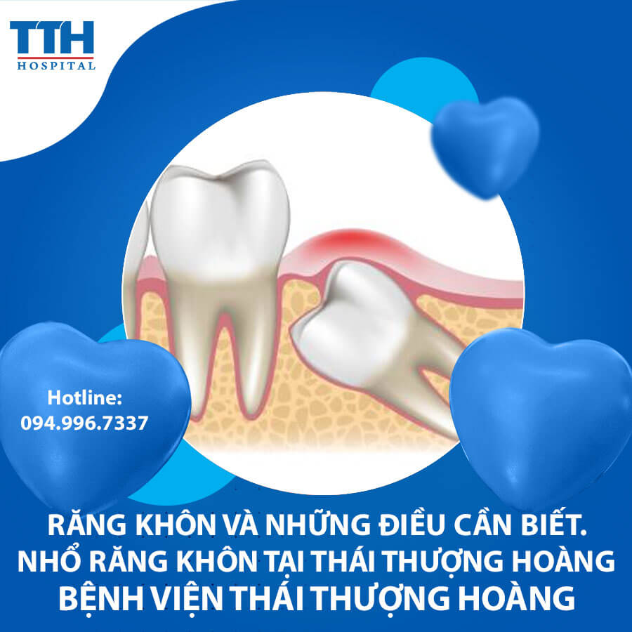 Răng khôn và những điều cần biết. Nhổ răng khôn tại Thái Thượng Hoàng