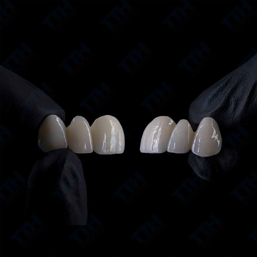 Răng Sứ Veneer Lisi Là Gì?