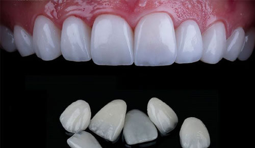 Răng Sứ Veneer Lisi Là Gì?