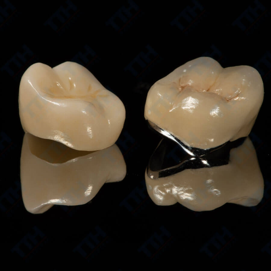 Răng Sứ Zirconia và Răng Sứ Kim Loại: Lựa Chọn Nào Tốt Hơn?