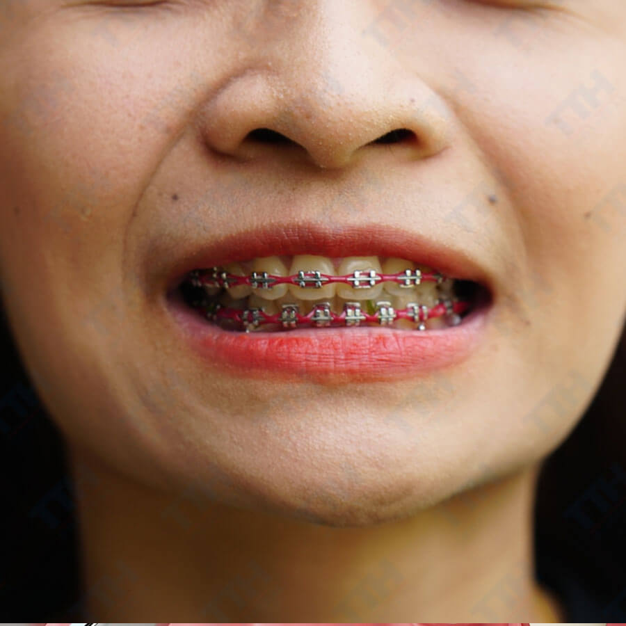 Sau khi tháo niềng làm gì để duy trì hàm răng đẹp