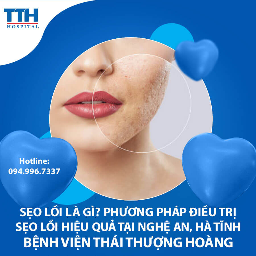 Sẹo lồi là gì? Phương pháp điều trị sẹo lồi hiệu quả tại Nghệ An, Hà Tĩnh