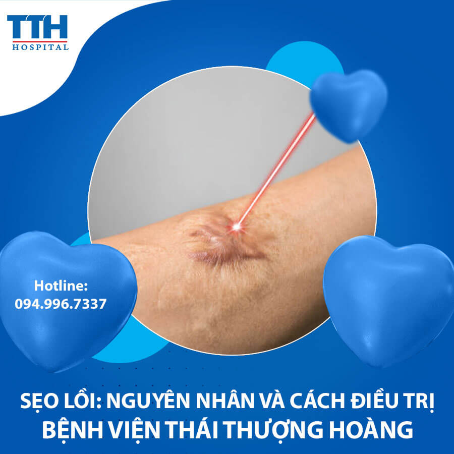 Sẹo lồi: Nguyên nhân và cách điều trị