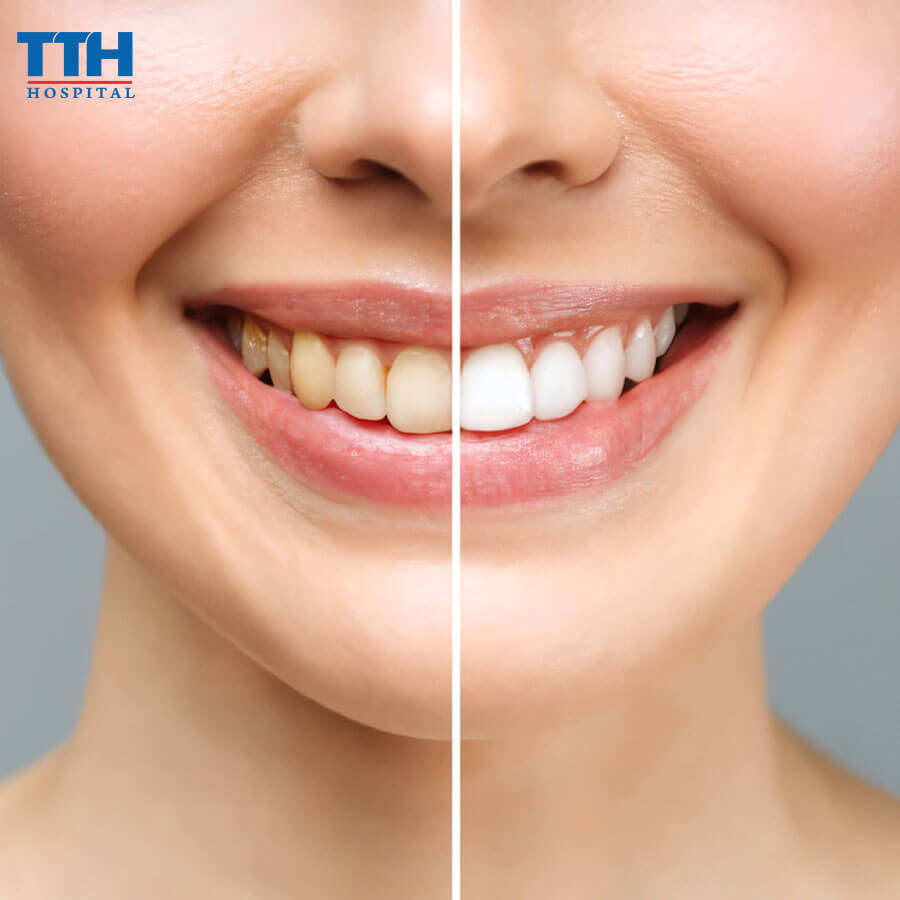 Tẩy Trắng Răng Tại Bệnh Viện Thái Thượng Hoàng