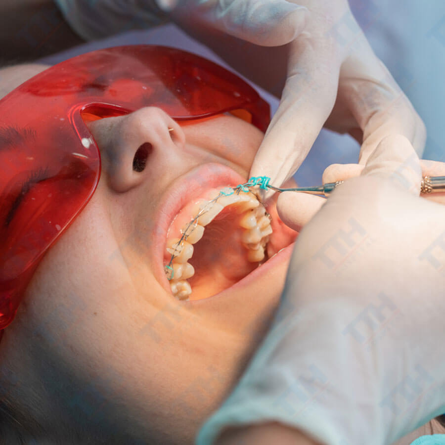 Tháo Niềng Răng: Làm Sao Để Răng Không Dịch Chuyển Lại?