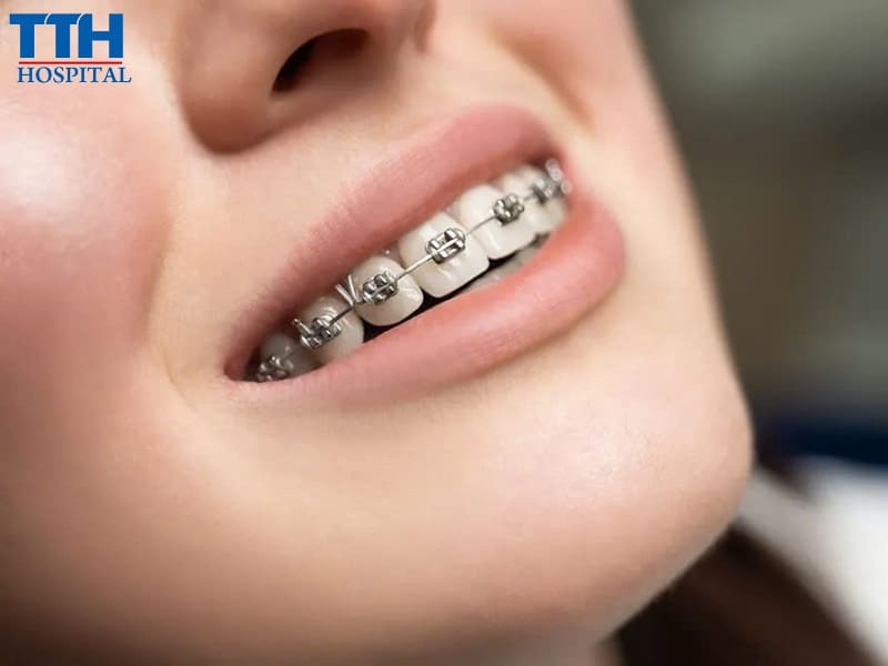 Thời điểm niềng răng phù hợp nhất là khi nào?