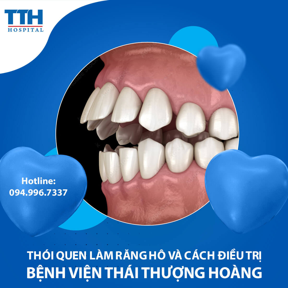 Thói quen làm răng hô và cách điều trị tại Vinh, Nghệ An - Chuyên gia chia sẻ
